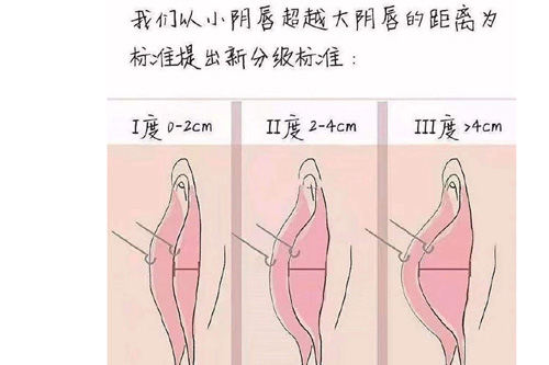 阴唇肥大参考题图