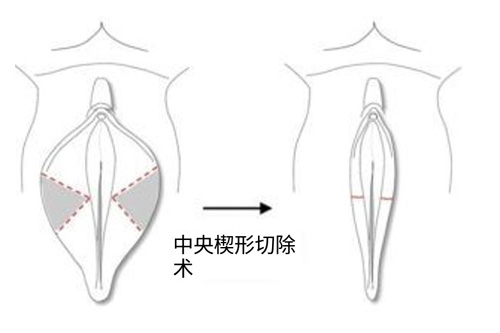 阴唇切除术