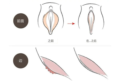 阴唇切除对比图