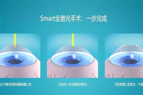 全激光手术过程图