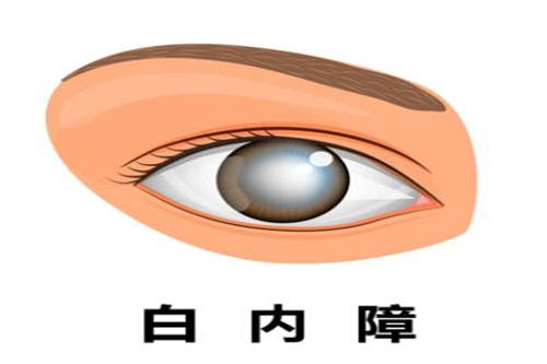 白内障漫画示意图