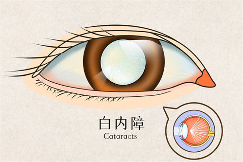 白内障细节图