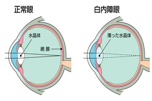 白内障与正常眼对比图