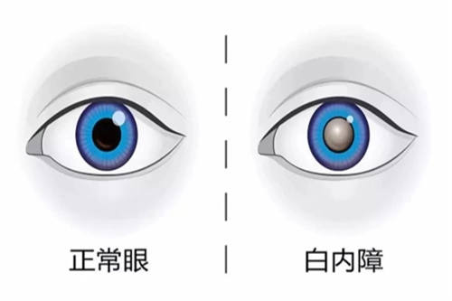 白内障与正常眼漫画对比图