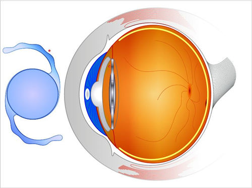 2024眼睛晶体植入手术价格公布!ICL晶体植入手术费及适合人群