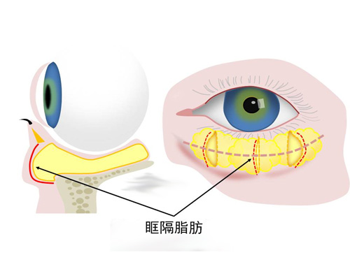 眶隔脂肪示意图