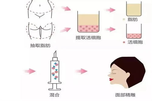 面部脂肪填充过程图