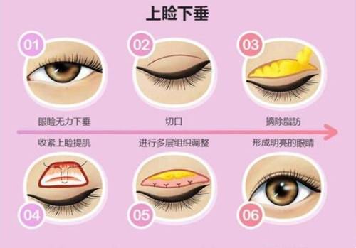 双眼皮提肌过程图示