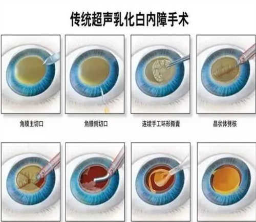人工晶体植入白内障治疗手术图