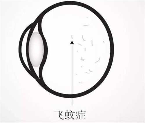 飞蚊症示意图