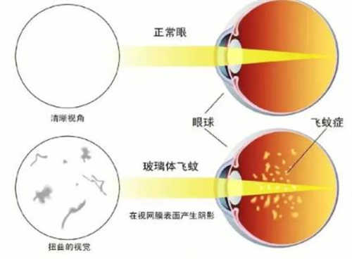 飞蚊症与正常眼球对比示意图