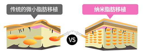 脂肪移植填充颗粒大小对比