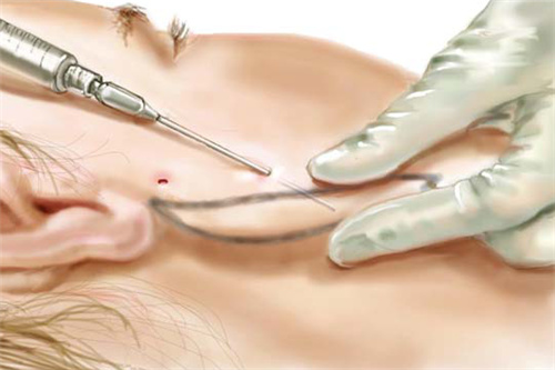 脂肪填充下颌线 脂肪填充下颌线