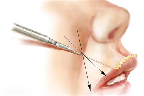 脂肪填充唇部 脂肪填充唇部