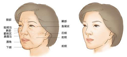 脂肪填充前后差异 脂肪填充前后差异