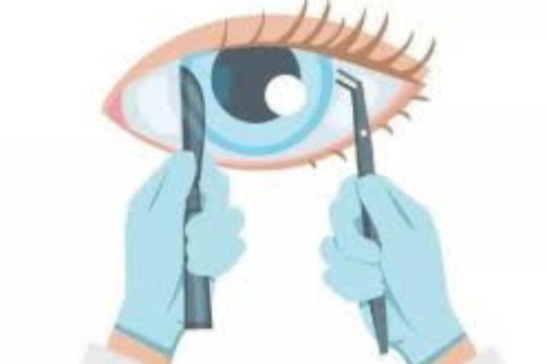 全飞秒近视眼手术操作展示图