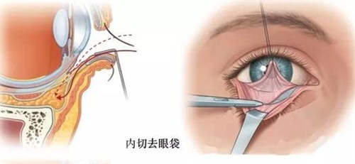 眼袋内切