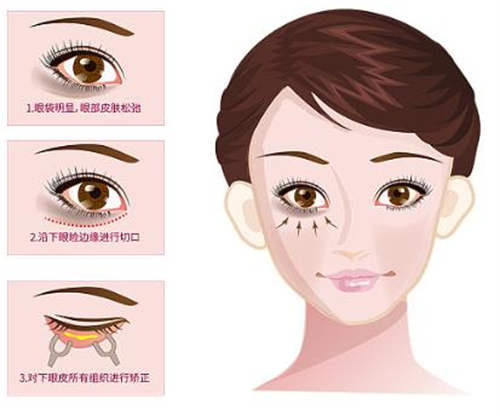 眼袋手术操作步骤