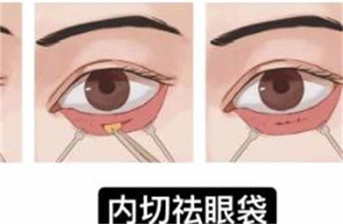 眼袋内切示意图