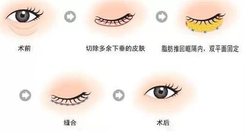 眼袋手术术前术后图