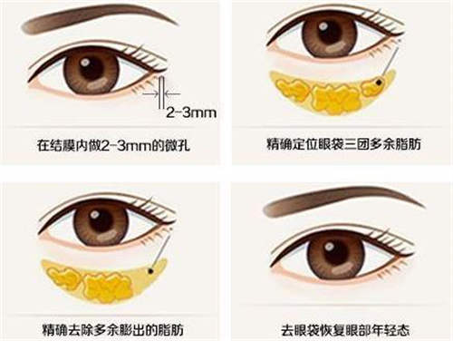 眼袋去除操作图