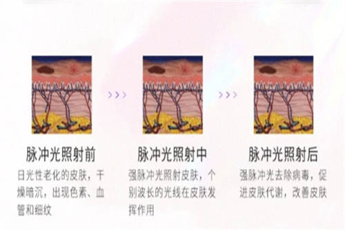 光子嫩肤步骤细节解析图