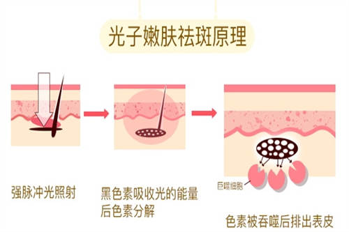 光子嫩肤祛斑原理图