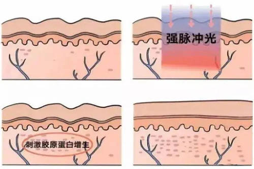 光子嫩肤示意图