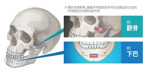 面部轮廓整形示意图