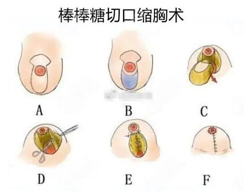 缩胸手术