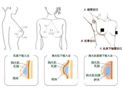 胸部手术示意图