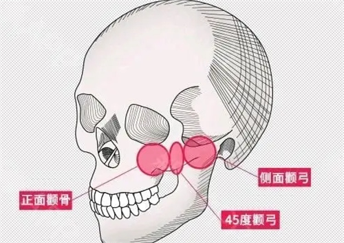 轮廓整形示意图