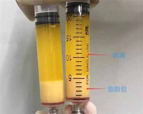 脂肪填充示意图