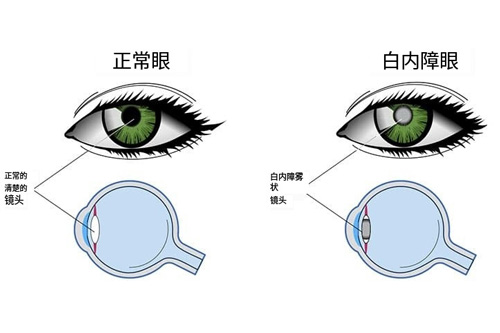 患白内障前后成像对比图