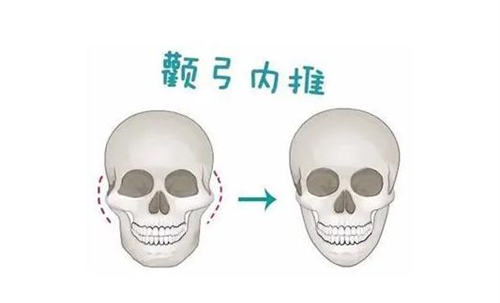 颧骨内推要不要做?恢复期多久?做治疗多少钱?