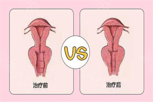 紧缩手术怎么做?需要多少钱?原理+收费价格,一并告知!