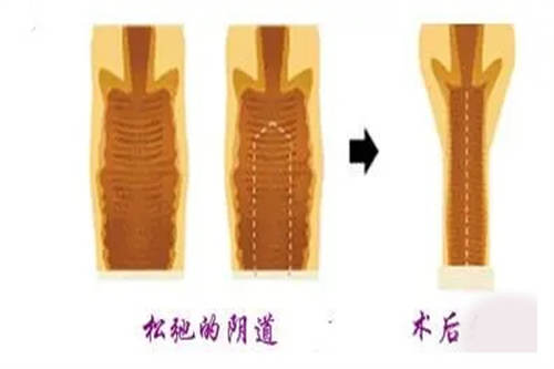 紧缩手术图