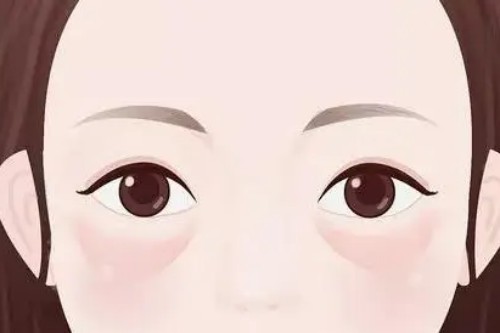 除眼袋手术宣传图