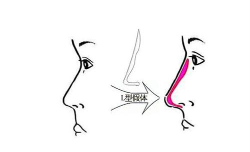 隆鼻L型假体示意图