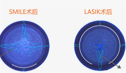 近视手术前后对比图