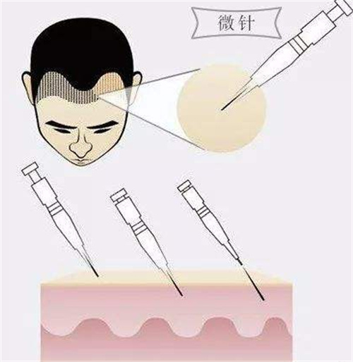 植发手术示意图