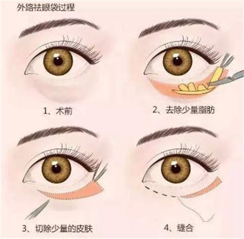 眼袋手术示意图