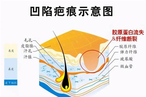 凹陷疤痕示意图