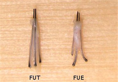 FUT和FUE毛囊取发不同