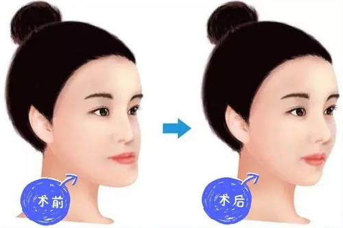 月亮脸矫正对比图