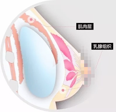 双平面丰胸卡通图