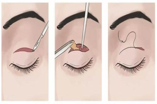 双眼皮手术过程图