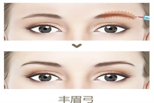 丰眉弓示意图
