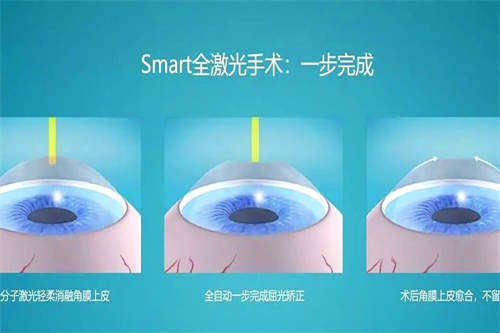 全飞秒手术过程图