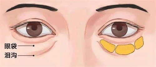 眼底脂肪分布图